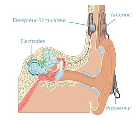 implants cochléaires