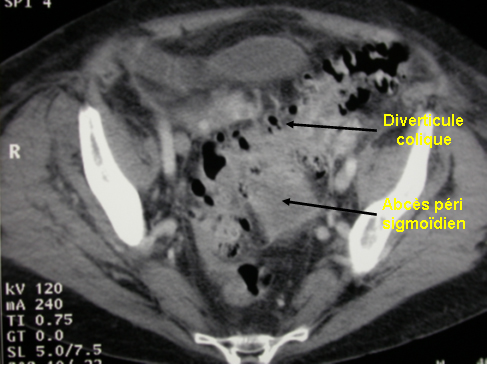 diverticulose colique